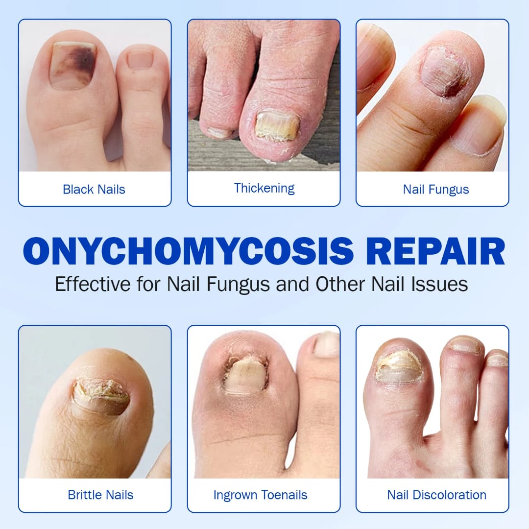 تلزيق لازالة فطريات الاظافر 21 لزقه — Antifungal Nail Treatment Patches – 21 Pieces